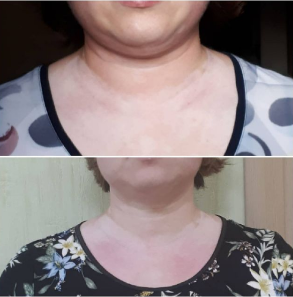 Результаты массажа лица Результаты массажа лица