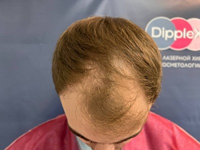 Долгожданные всходы: правда и мифы про пересадку волос 1 Долгожданные всходы: правда и мифы про пересадку волос 1