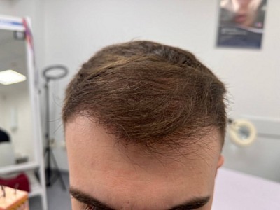 Долгожданные всходы: правда и мифы про пересадку волос 2 Долгожданные всходы: правда и мифы про пересадку волос 2