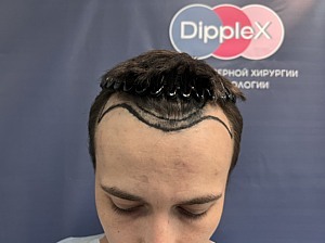 Долгожданные всходы: правда и мифы про пересадку волос 3 Долгожданные всходы: правда и мифы про пересадку волос 3