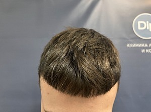 Долгожданные всходы: правда и мифы про пересадку волос 4 Долгожданные всходы: правда и мифы про пересадку волос 4