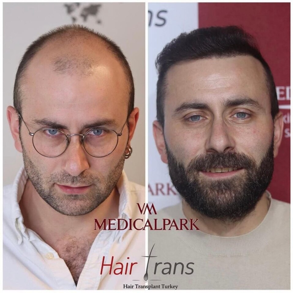 Новый уровень пересадки волос: челябинцам стали доступны мировые технологии 4 Новый уровень пересадки волос: челябинцам стали доступны мировые технологии 4