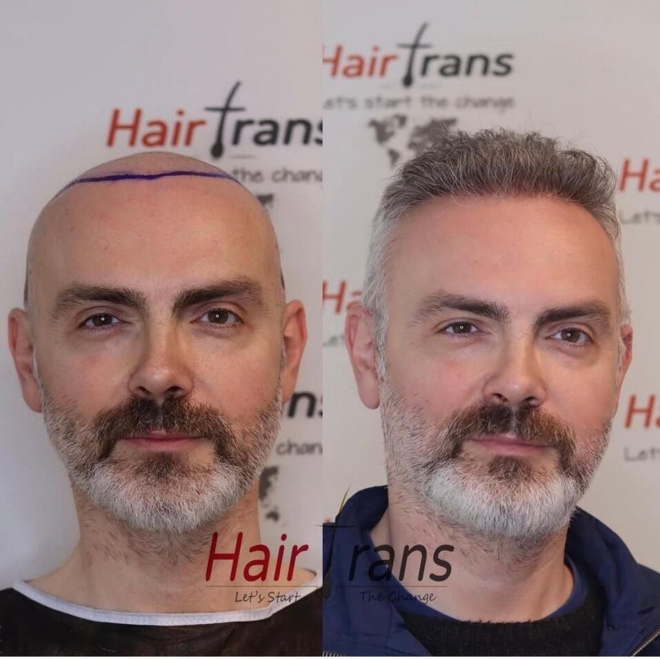 Новый уровень пересадки волос: челябинцам стали доступны мировые технологии 5 Новый уровень пересадки волос: челябинцам стали доступны мировые технологии 5