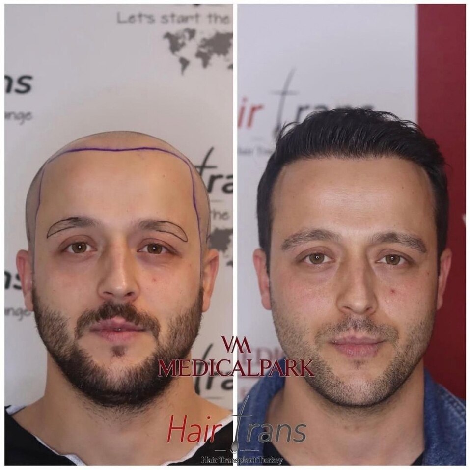 Новый уровень пересадки волос: челябинцам стали доступны мировые технологии 6 Новый уровень пересадки волос: челябинцам стали доступны мировые технологии 6